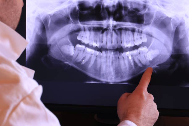Best Emergency Dentist for Lost Fillings or Crowns in Pomona, NJ